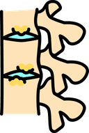 Spondylitis